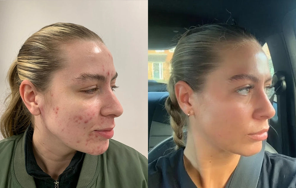 Before and after results using Lifara patches